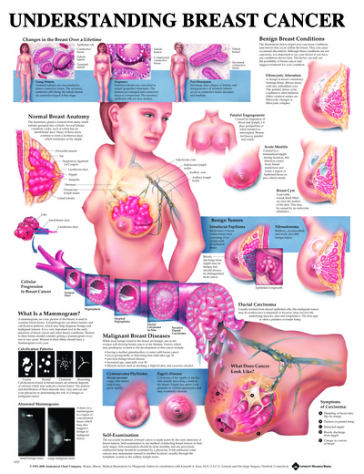 Understanding Breast Disease Poster